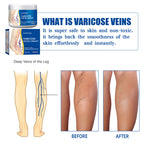 Leg Vein Relief Cream